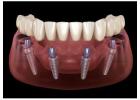 All-on-4 Dental Implants in Tijuana, Mexico – Affordable, Life-Changing Results!