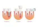 Same-Day Crowns  in Las Vegas at Functional Aesthetic Dentistry