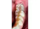 Dental implants Tijuana offers natural-looking and durable teeth replacements