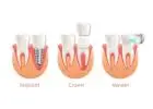 Get a Perfect Smile with Same-Day Crowns in Las Vegas!