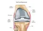 Regain Mobility with Total Knee Replacement Surgery