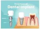 Affordable Dental Implants – Restore Your Confident Smile