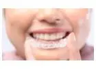Affordable Braces Singapore – Straighten Your Smile with Expert Care