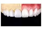 Find minimally invasive Veneers in Tijuana with ultra-thin custom-made shells