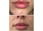 Best Service For Lip Fillers in CityPlace
