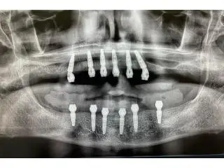 Find top-notch surgeons and dental equipment for Wisdom teeth removal Tijuana Find top-notch surgeons and dental equipment for Wisdom teeth removal Tijuana