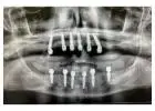 Find top-notch surgeons and dental equipment for Wisdom teeth removal Tijuana