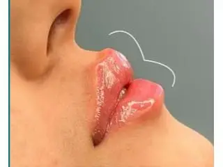 Best Lip Filler Injection clinic in St Albans Best Lip Filler Injection clinic in St Albans