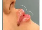 Best Lip Filler Injection clinic in St Albans
