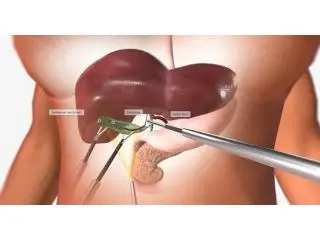 Top Liver Replacement Surgery | Maddadgar Foundation Top Liver Replacement Surgery | Maddadgar Foundation