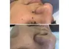 Laser removal of skin tag