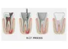 Save Your Tooth – Advanced Root Canal Treatment in Noida