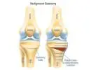 Osteotomy Surgery for Better Knee Balance
