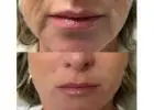 Best Lip Fillers treatment in Cheltenham