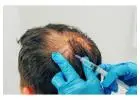 Best Hair Loss Treatment in Kampong Glam