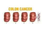 Age and Colon Cancer Symptoms: What Different Generations Need to Know