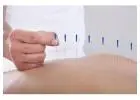 Best Acupuncture Therapist in Paddington