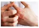 Trusted Legal Help for Occupational Dermatitis Claims in Bolton