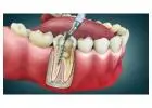 Root Canal Treatment in Thane | Best Dentist for RCT