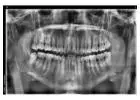 Get your natural look with metal-free Dental crowns in Tijuana from Teeth Savers