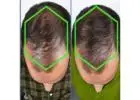 Best Men's Hair Loss Treatment in Barking