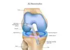 Torn ACL Surgery Begins with the Right Diagnosis