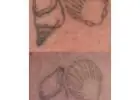 Best Laser Tattoo Removal in Port Macquarie