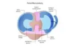 Understanding Partial Meniscectomy for Meniscus Tears