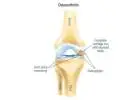 Arthritis Knee Treatment Options Worth Understanding First