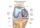 Is Partial Knee Arthroplasty Right for Your Knee?