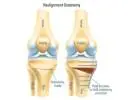 Protect Your Knee with Osteotomy Surgery