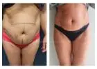 Best Fat Freezing treatment in Perth