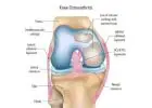 Improve Knee Function with Partial Knee Arthroplasty